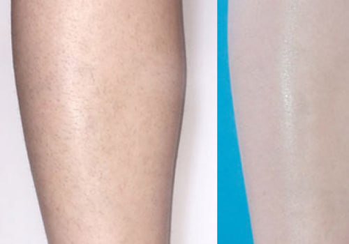 How Long Does it Take to See Results After Laser Hair Removal?