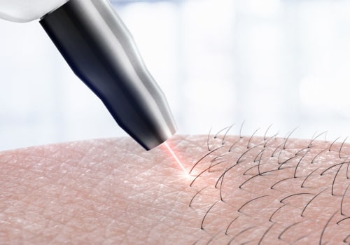 Preparing Your Skin for Laser Hair Removal: A Comprehensive Guide